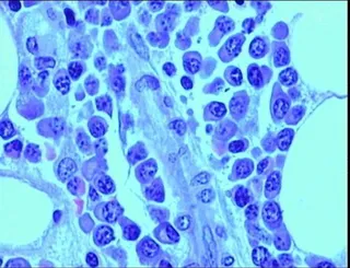 Una investigación sobre mieloma múltiple, premiada como mejor tesis doctoral en cáncer