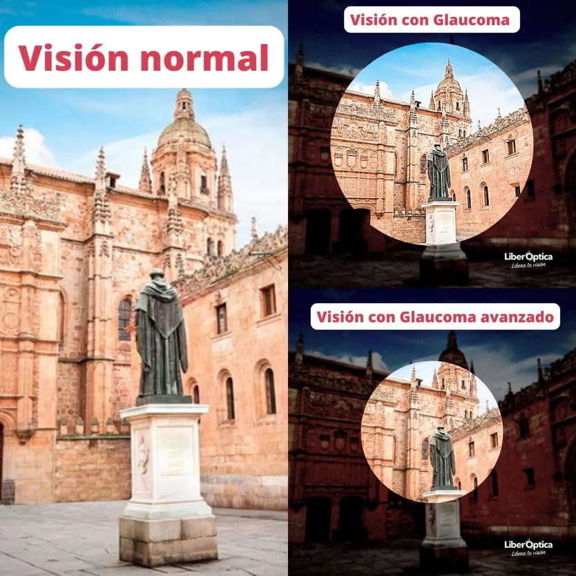 Visión con glaucoma. Foto Colegio de Ópticos de Salamanca