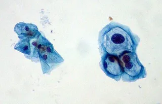 Virus del Papiloma Humano (VPH)