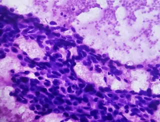 De utilizarse durante el posparto a poder ser útil para reducir el riesgo de cáncer de mama - USAL