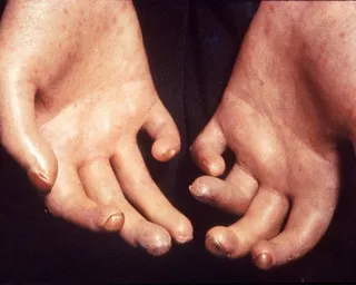 Esclerodermia