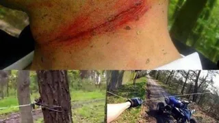 Herida cuello
