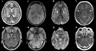 Radiografia cerebro. Foto de archivo